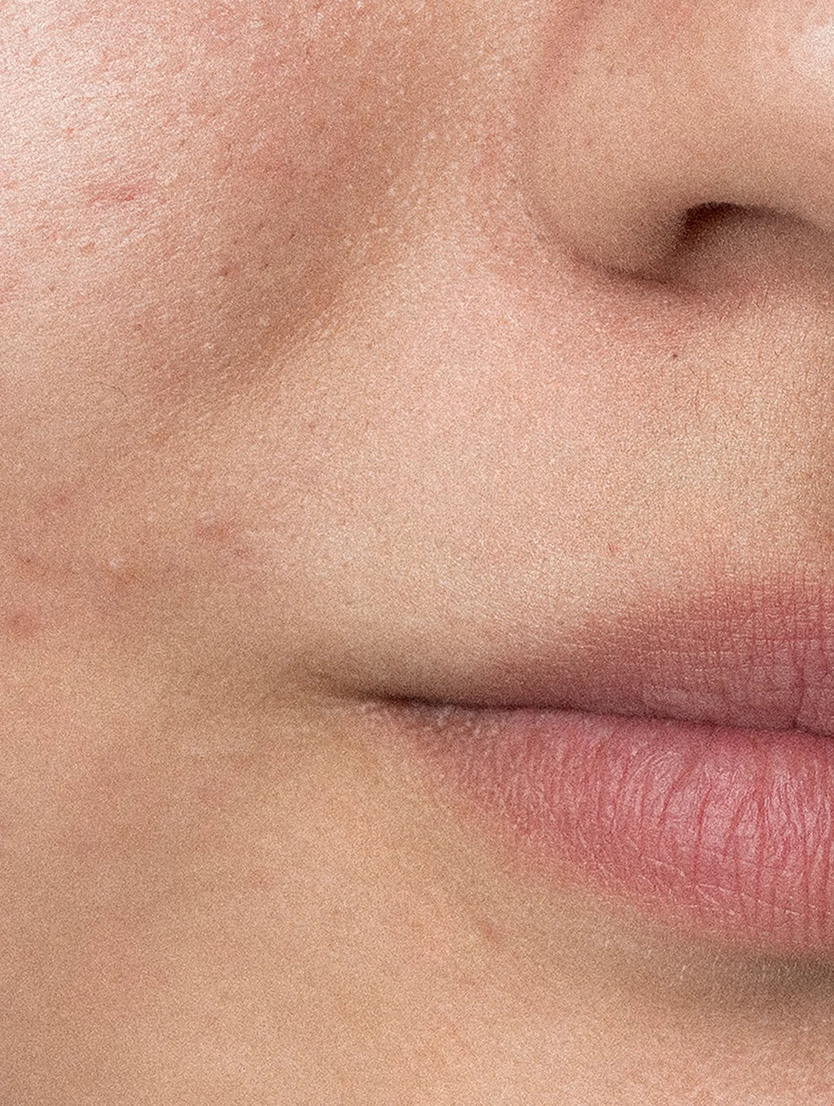 Acne-Prone Skincare Bundle